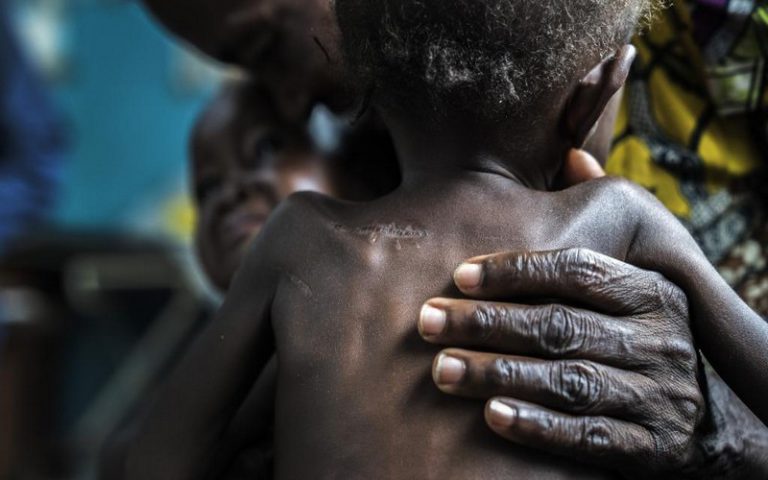 RDC : les ONG invitent à soutenir 400 000 enfants malnutris au Kasaï