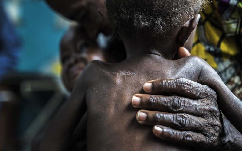 RDC : les ONG invitent à soutenir 400 000 enfants malnutris au Kasaï