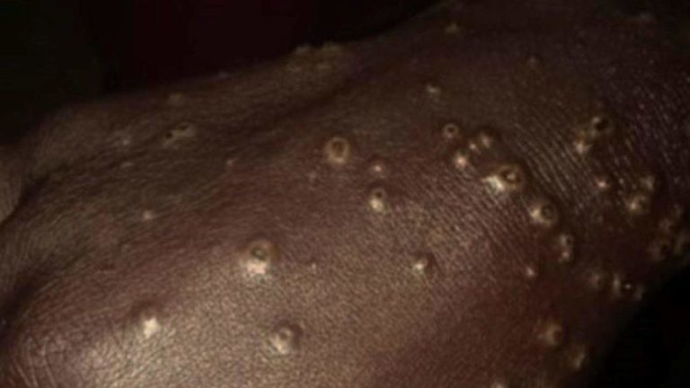 SENEGAL-Panique à Thiaroye sur mer: une maladie mystérieuse fait des ravages