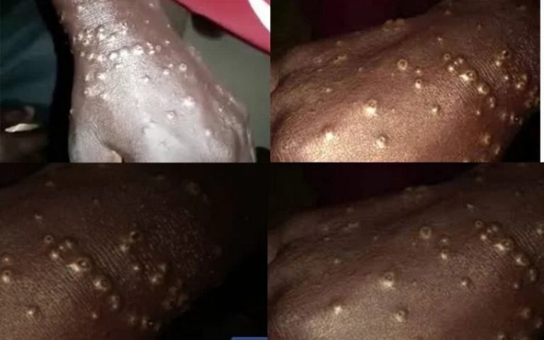 Une « maladie mystérieuse des pêcheurs » réapparaît au Sénégal, la situation sous contrôle